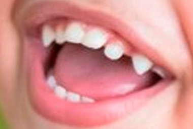 Hutchinson Dişleri