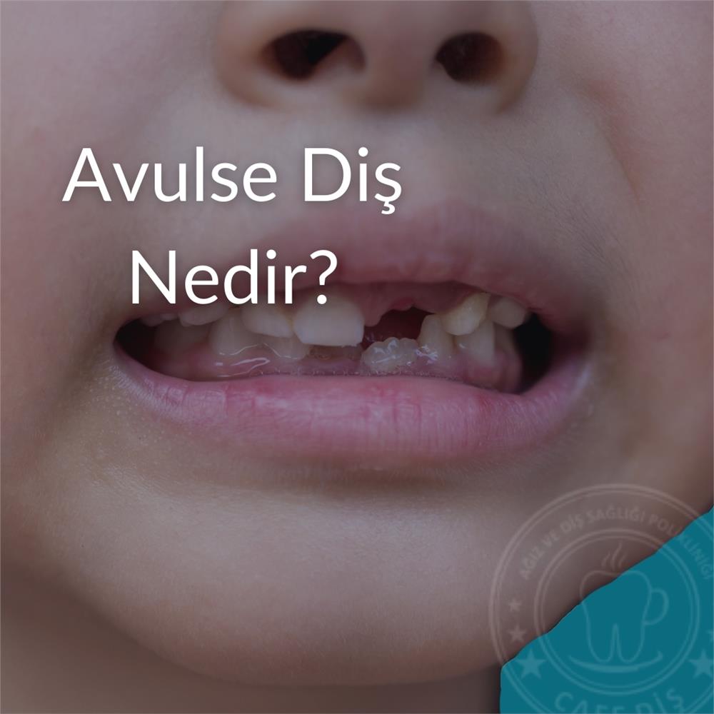 Avülse Diş