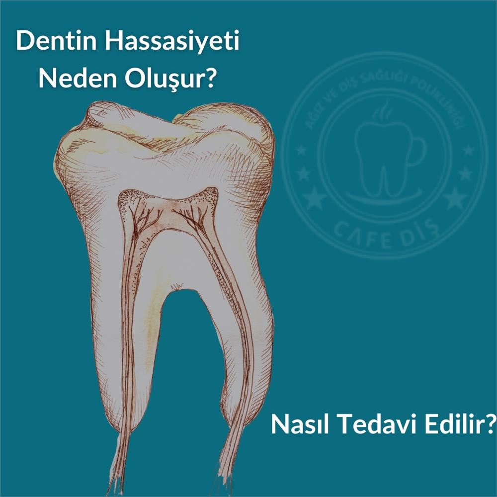 Dentin Hassasiyeti