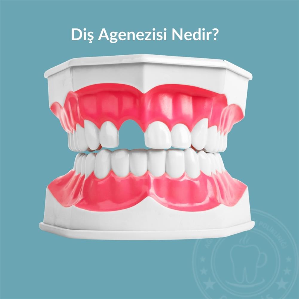 Diş Agenezisi