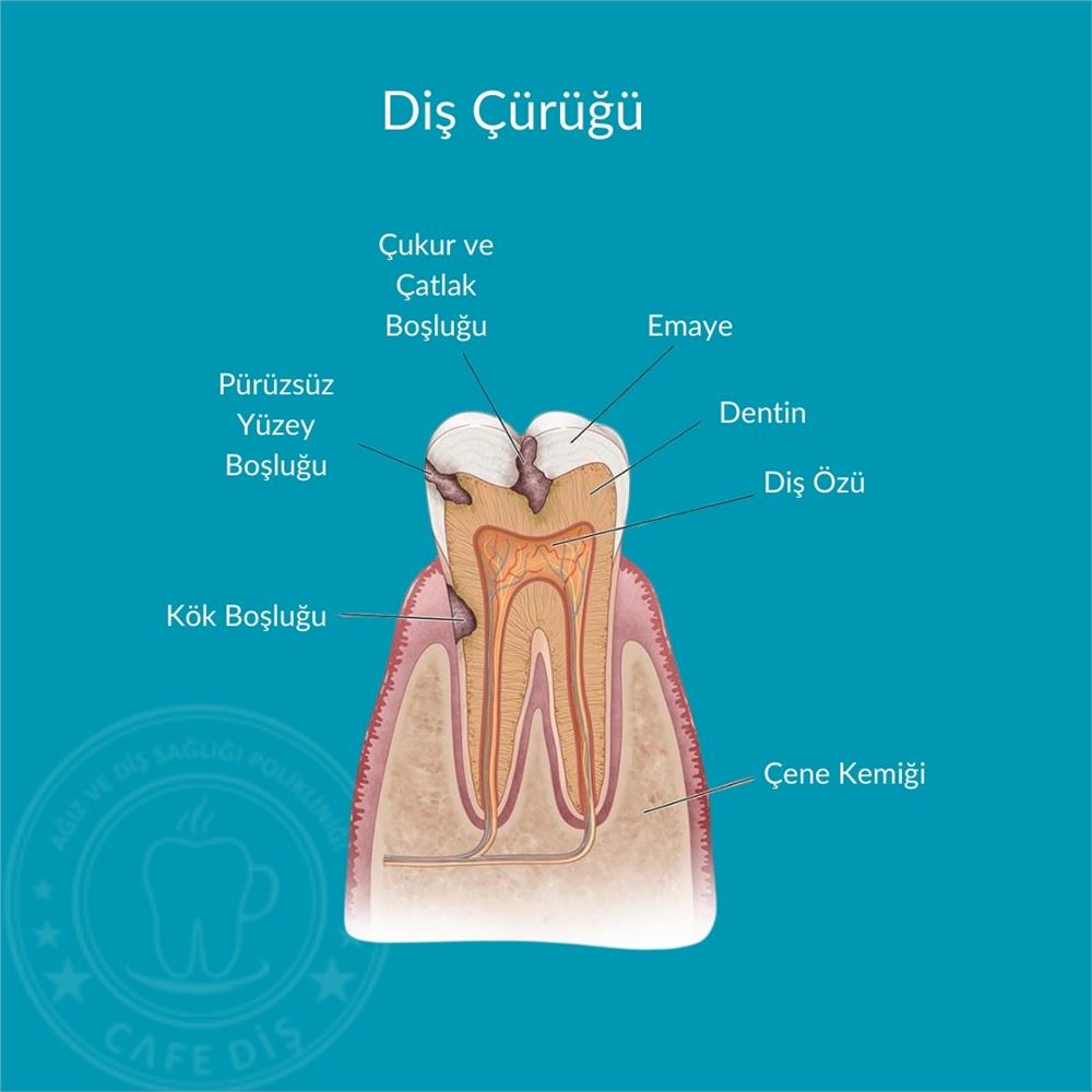 Diş Çürüğü Diş Çürüğü