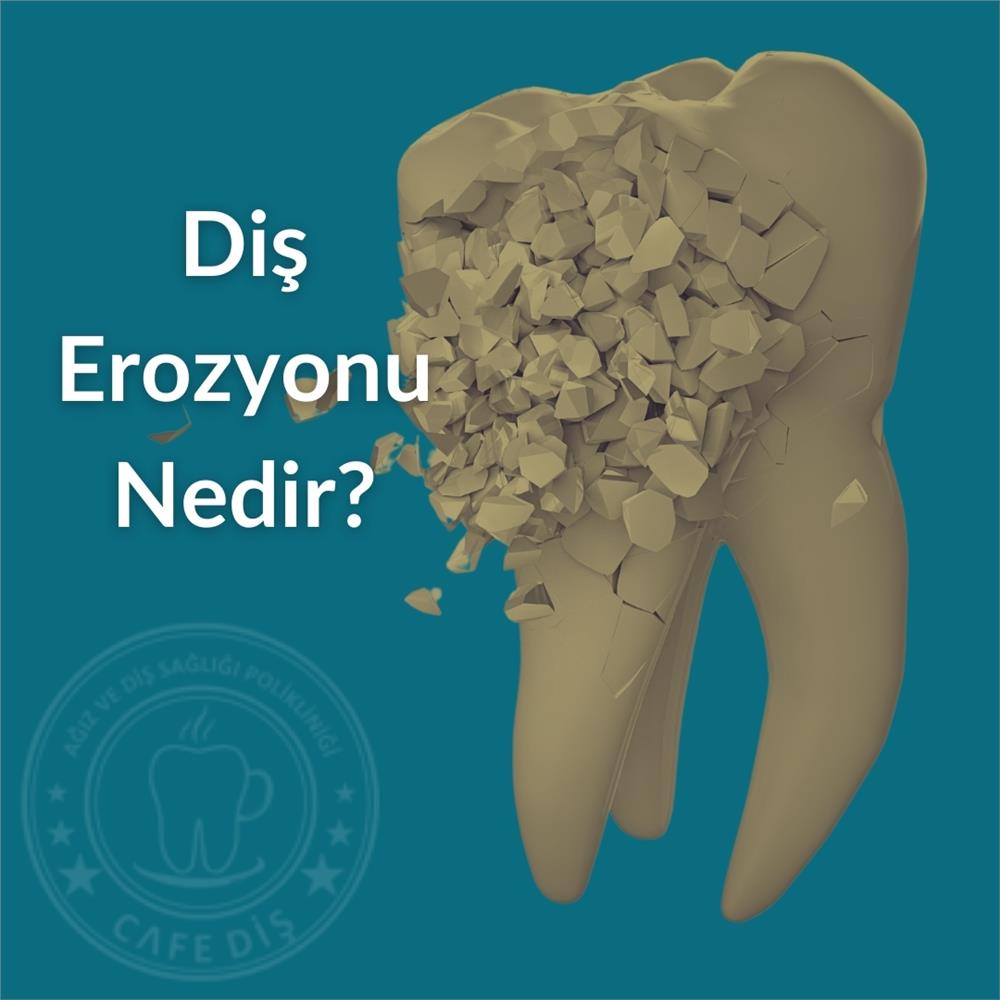 Diş Erozyonu