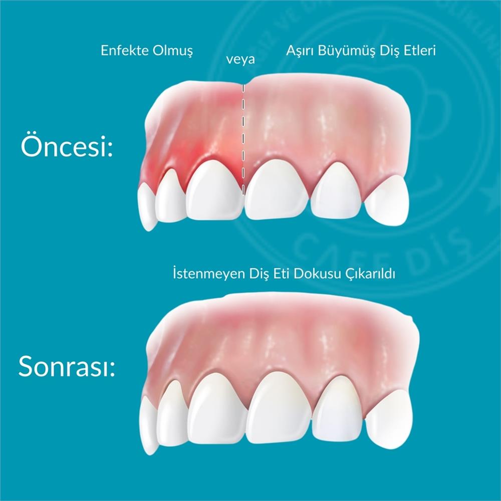 Diş Eti Estetiği Nedir?
