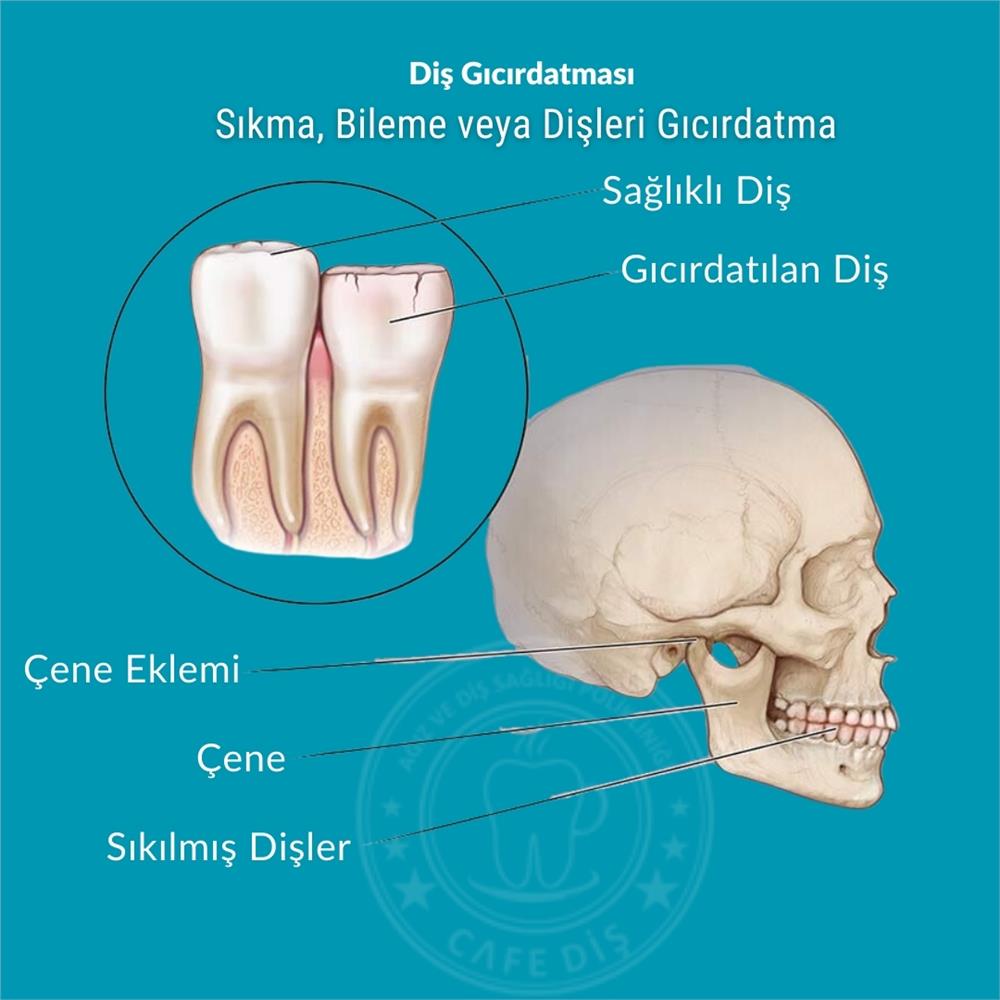 Diş Gıcırdatma