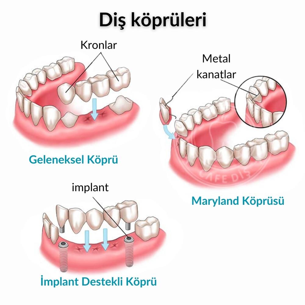 Diş Köprüleri