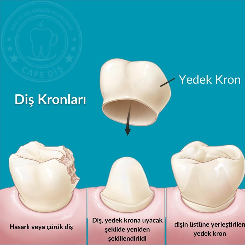 Diş Kronları