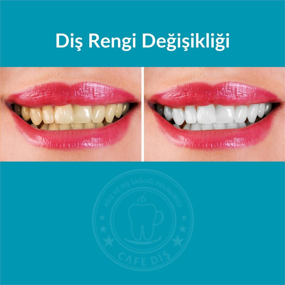 Diş Rengi Değişikliği