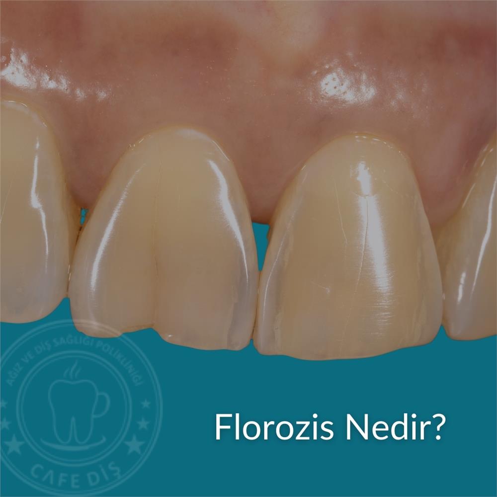 Florozis Nedir Florozis Nedir