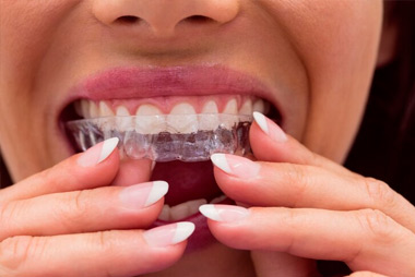 Invisalign Tedavisine Başlamadan Önce Bilmeniz Gereken 9 Şey