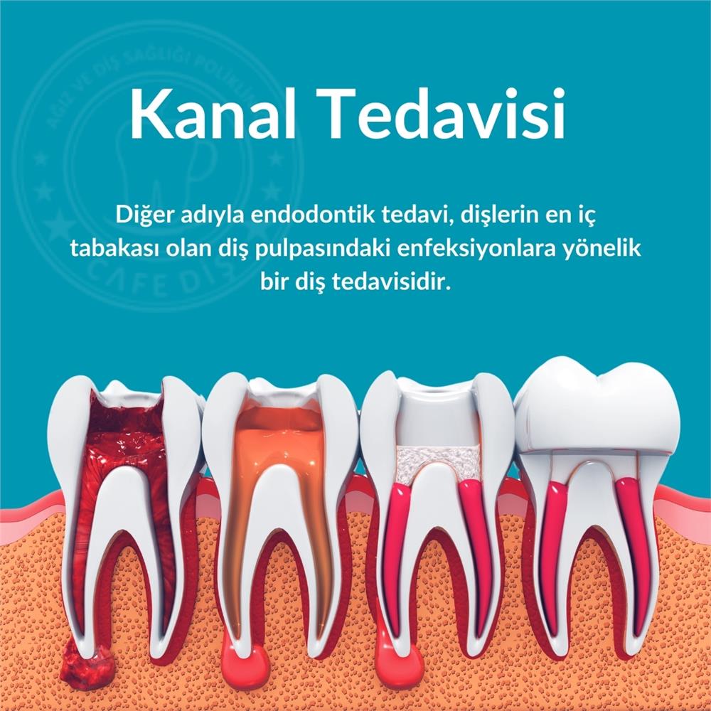 Kanal Tedavisi