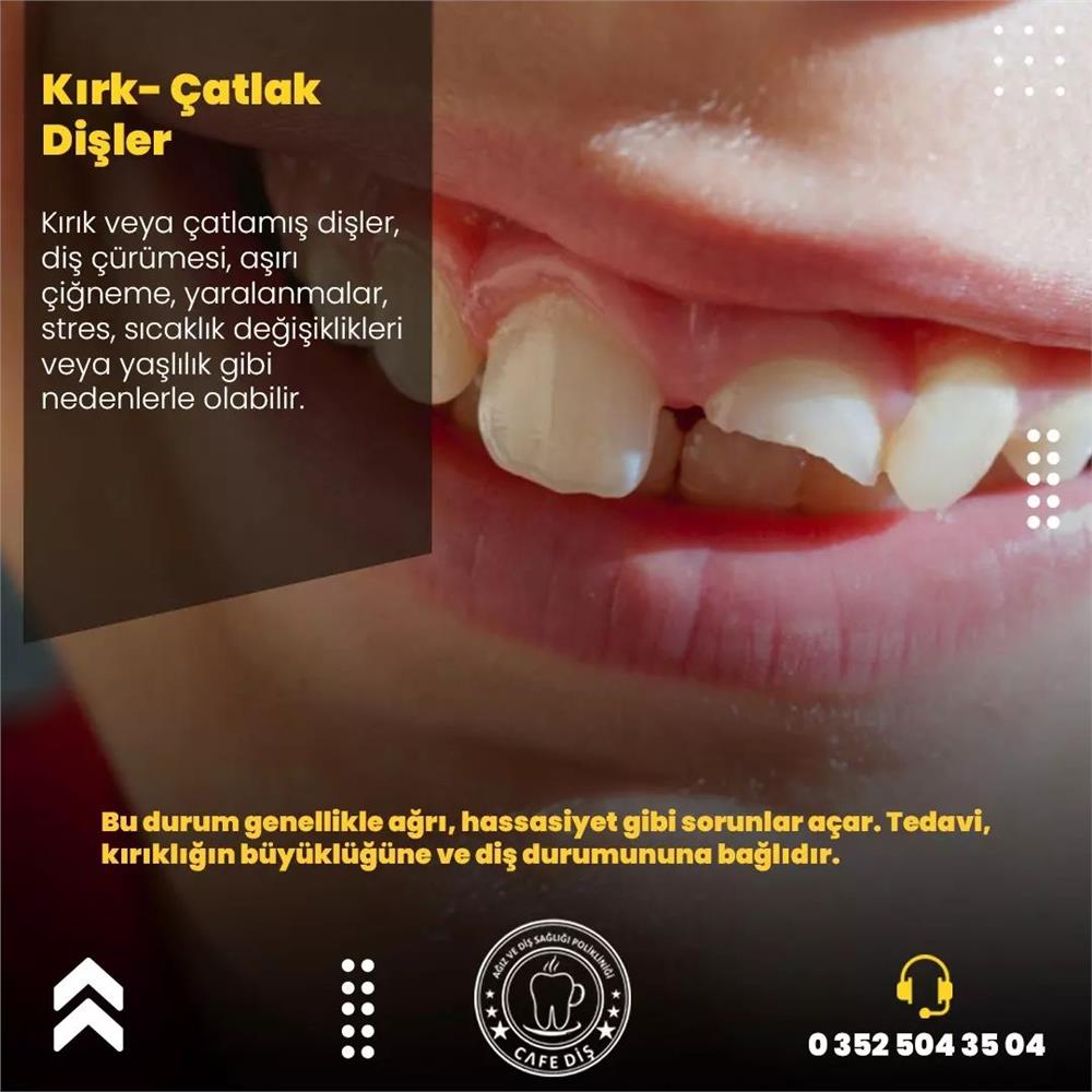 Kayseri Kırık - Çatlak Diş Tedavisi