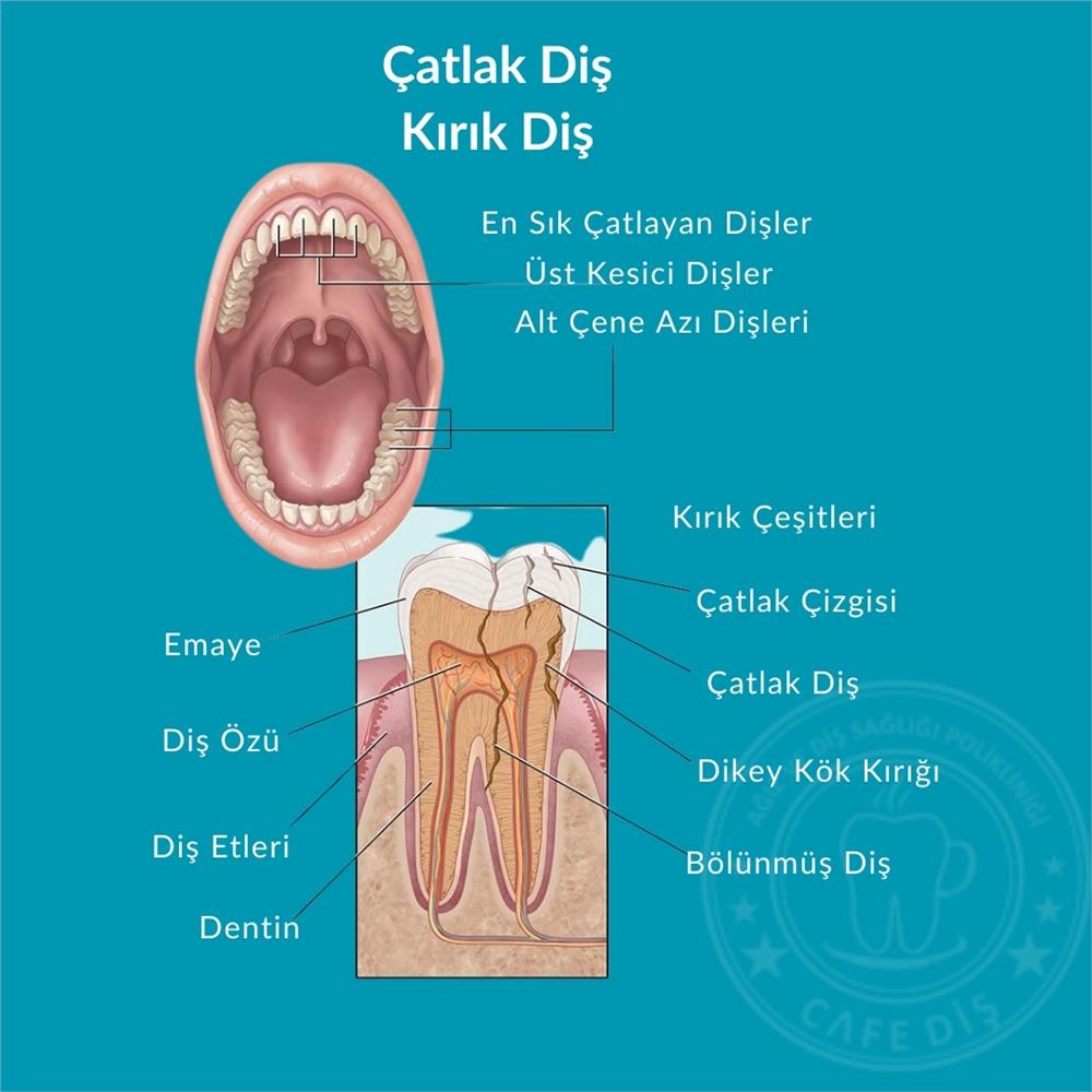 Kırık-Çatlak Diş Kırık-Çatlak Diş