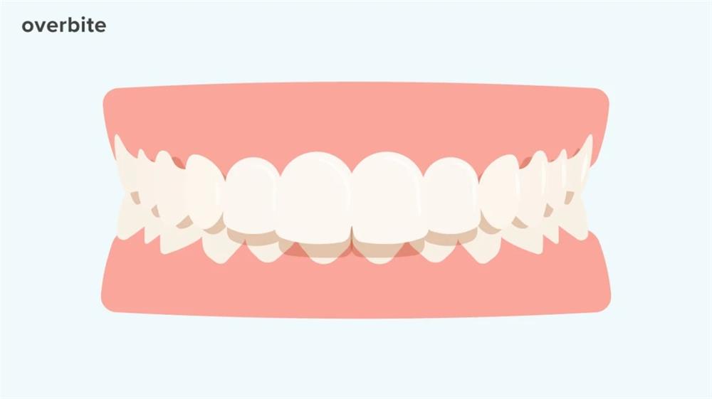 Overbite modeli