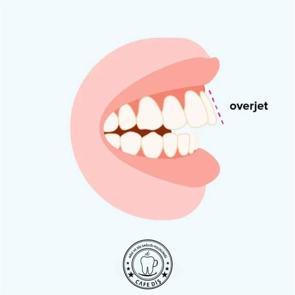 overjet nedir sorusuna cevap niteliğinde olan overjet modeli